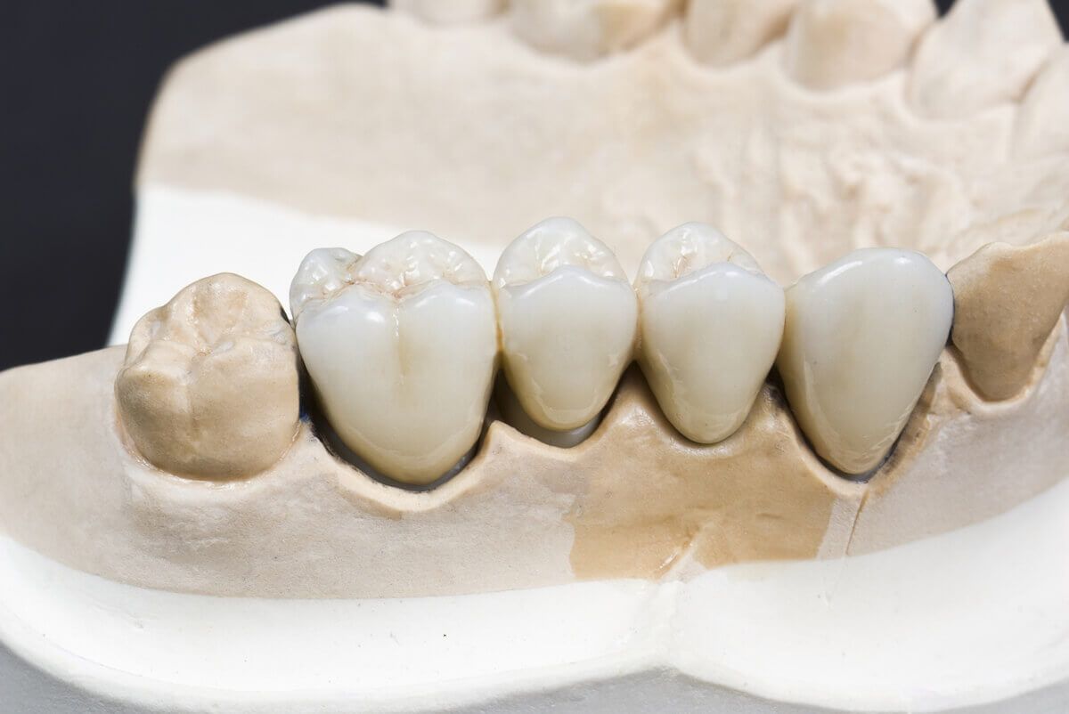 протезирование зубов металлокерамическими коронками