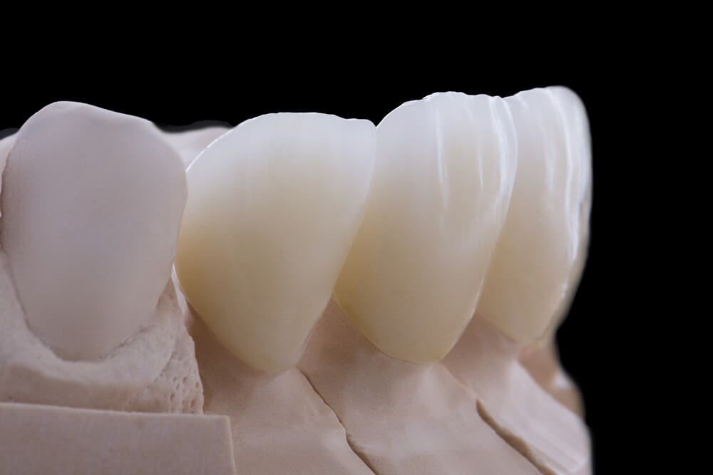 протезирование зубов красивыми керамическими коронками