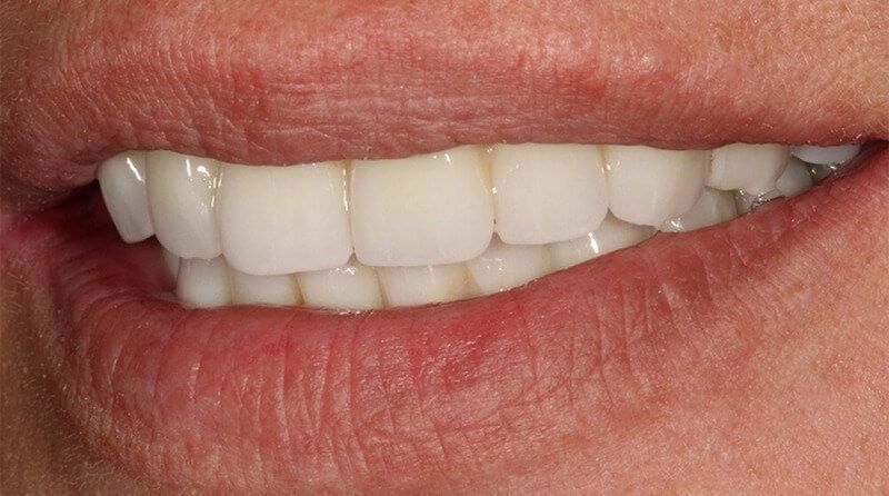 высоко эстетичные протезы All-on-6 неотличимые от собственных зубов