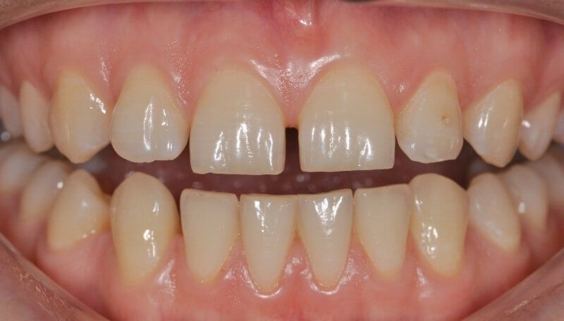 диастема исправляется установкой виниров на зубы