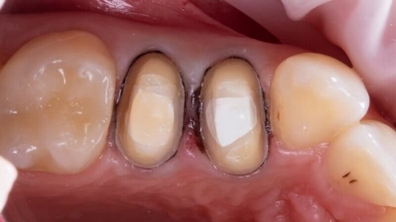 Оба зуба были подготовлены под протезирование циркониевыми коронками
