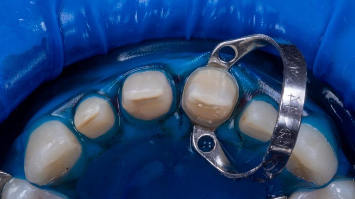 изолированные для обработки зубы