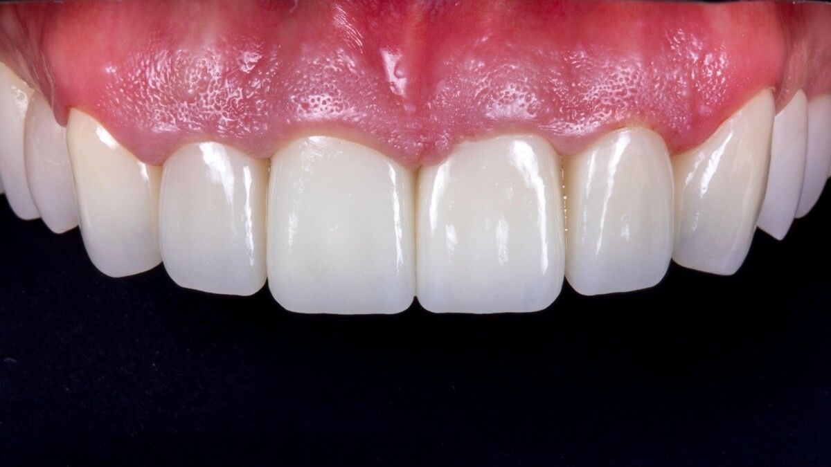 Передние зубы после протезирования циркониевыми коронками
