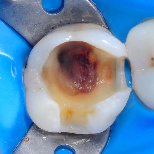 зуб после удаления старой пломбы и кариеса под ней