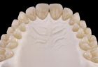 протезирование всех зубов циркониевыми коронками