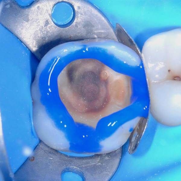 лечение кариеса под пломбой на жевательном зубе