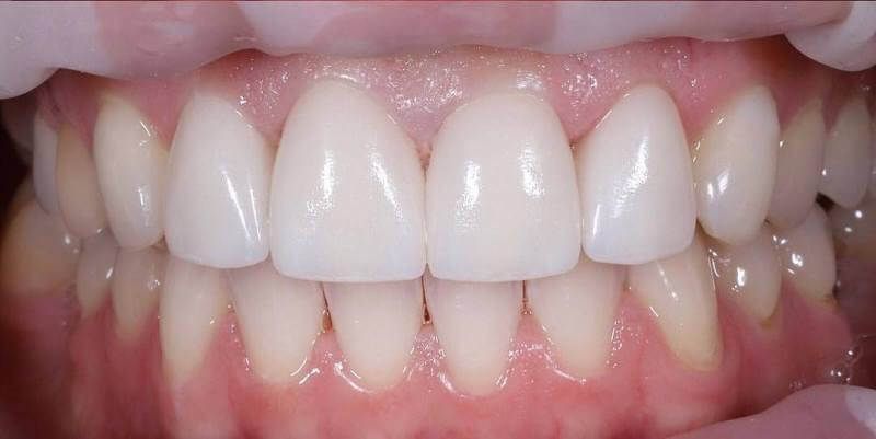 лечение кариеса и эстетическая реставрация передних зубов