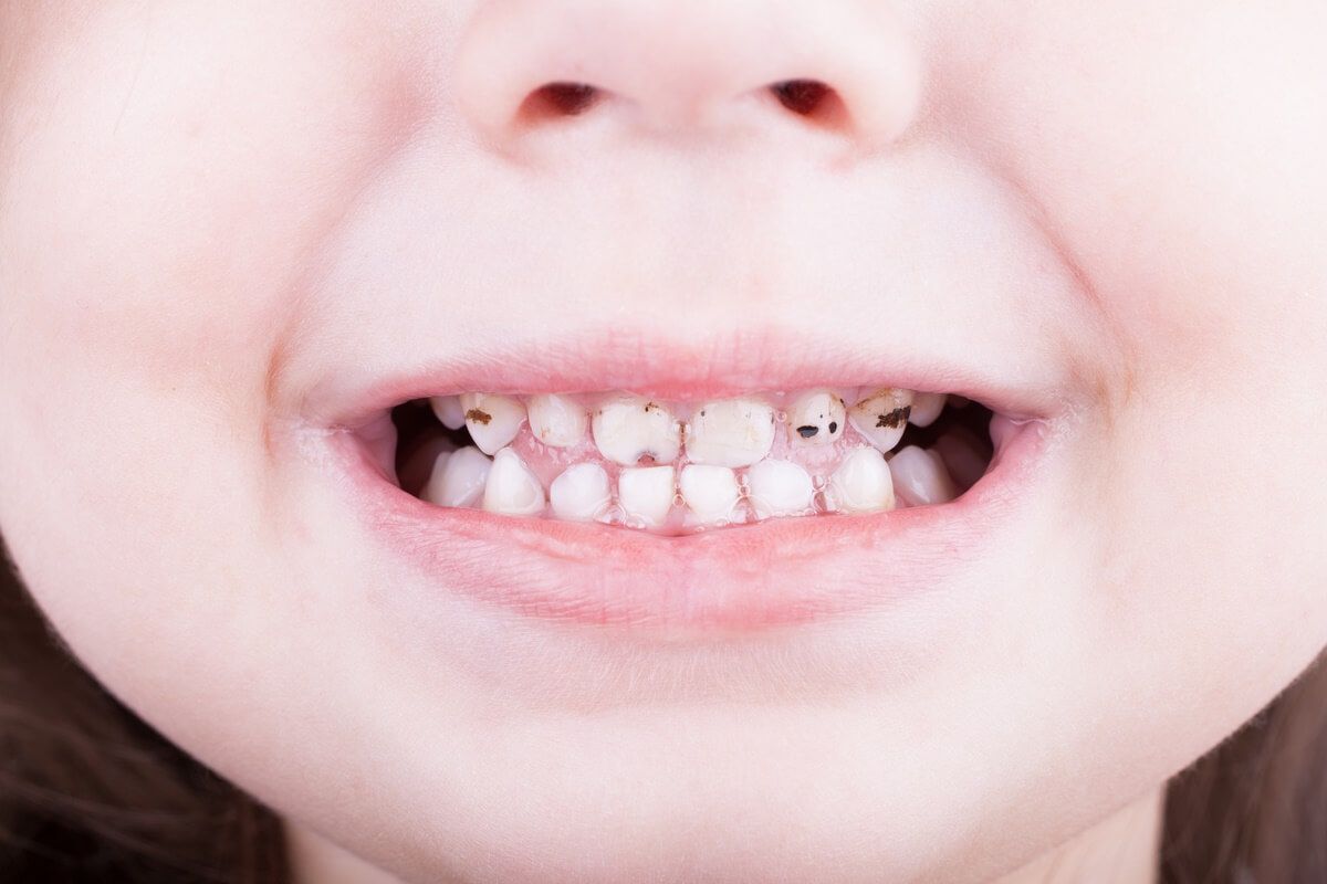 развитие кариеса молочных зубов можно замедлить