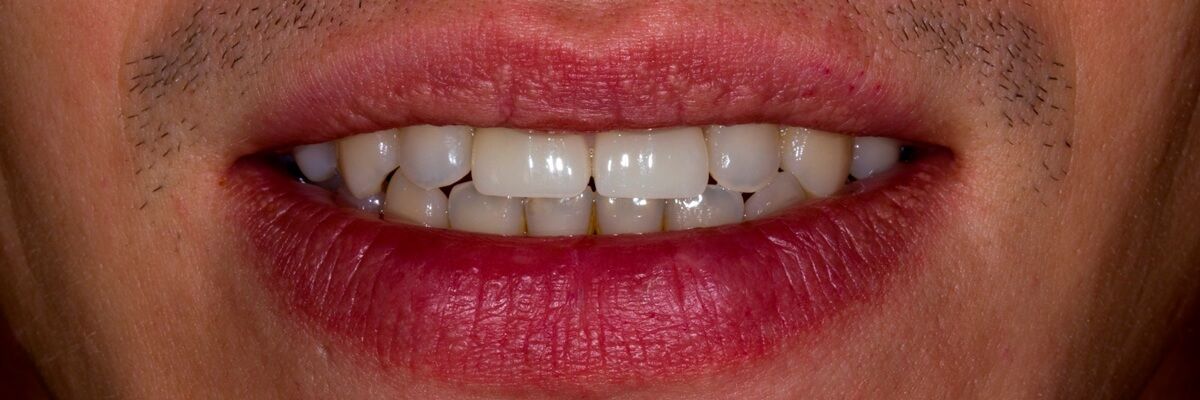 фото после установки керамических коронок на передние зубы