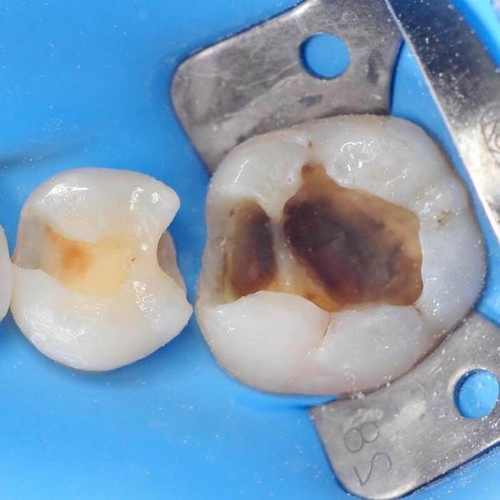 фото зуба до и после лечения кариеса под пломбой