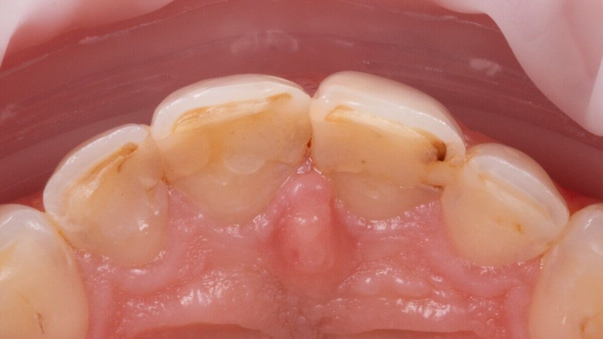 стираемость эмали зубов