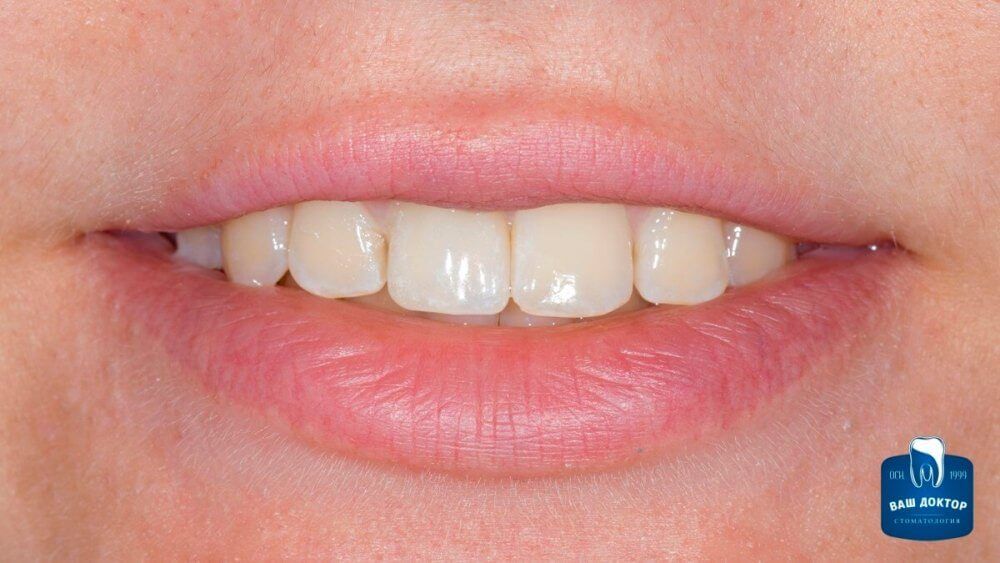 передний зуб после установки Emax коронки