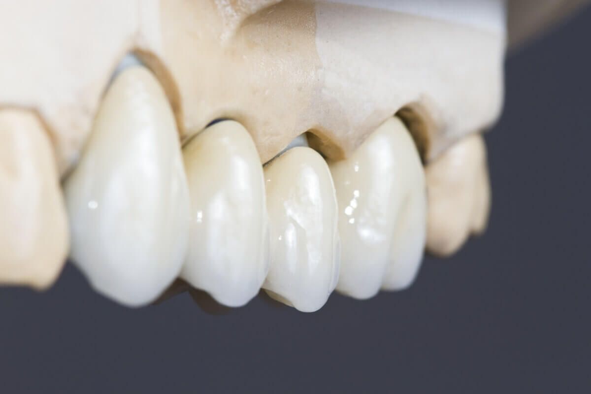 металлокерамическая коронка на зубы