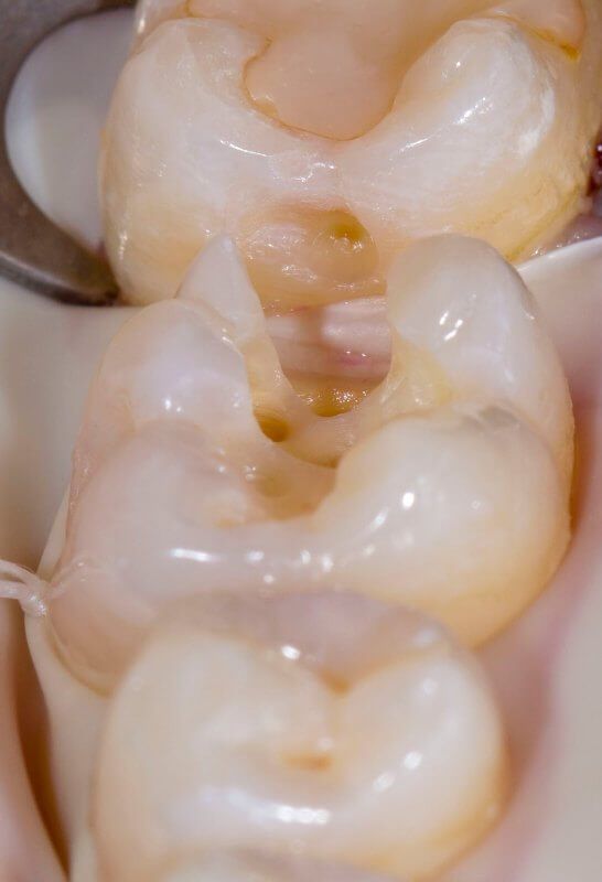зуб в процессе лечения кариеса
