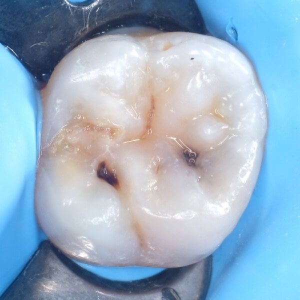 изолированный жевательный зуб с кариесом фиссур