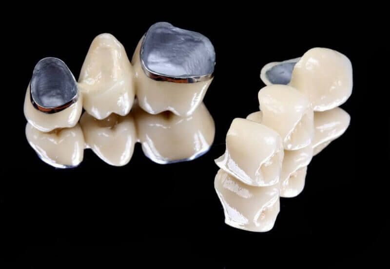 металлокерамические мосты на зубы