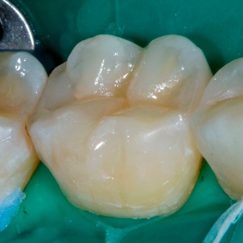 жевательный зуб после замены старой композитной пломбы