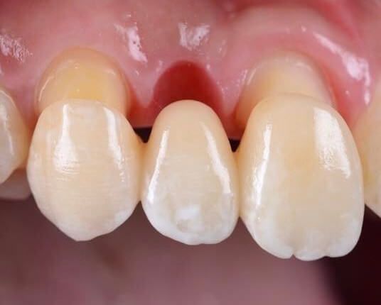 зубы запротезированные мостом из диоксида циркония