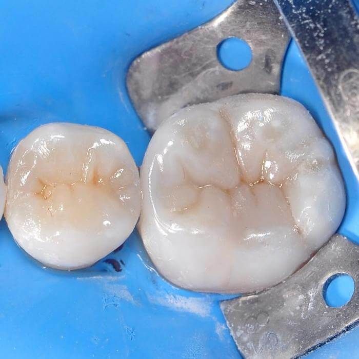 здоровый зуб после лечения кариеса под пломбой