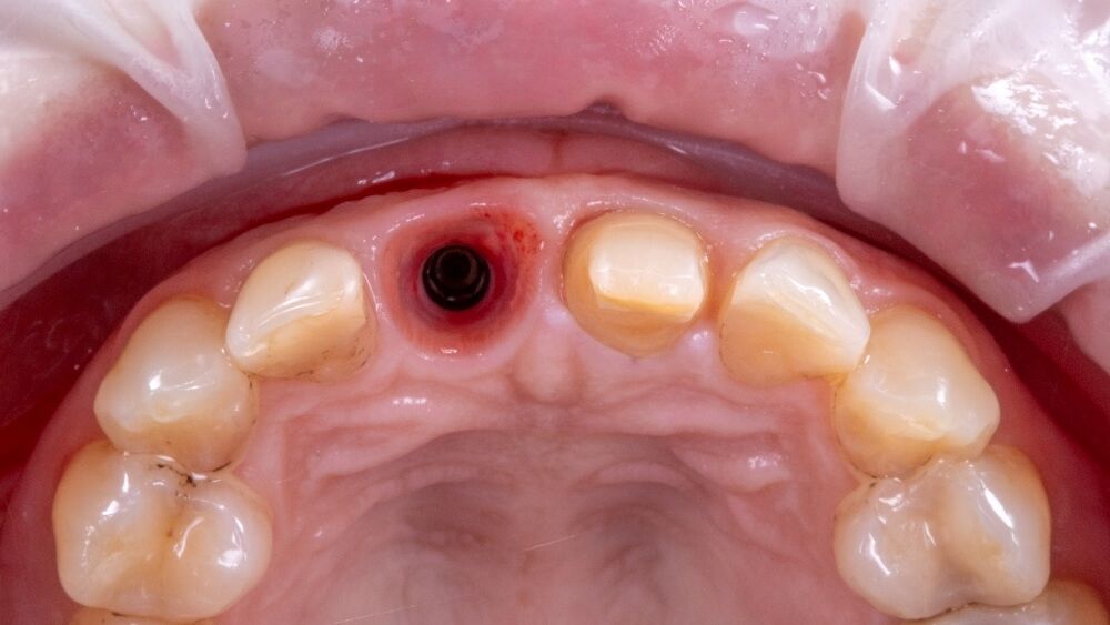 имплантат установленный в позицию переднего зуба
