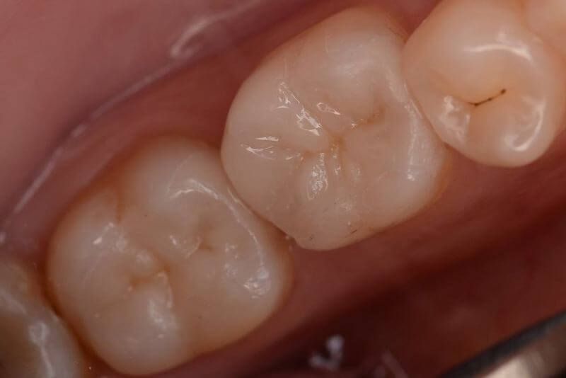 зубы после лечения кариеса с применением керамических вкладок