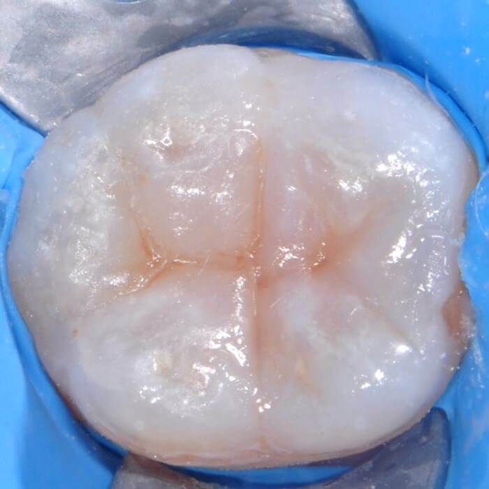 здоровый жевательный зуб после удаления кариеса под пломбой