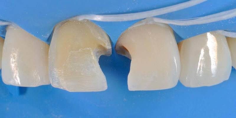 замена пломбы на передних зубах