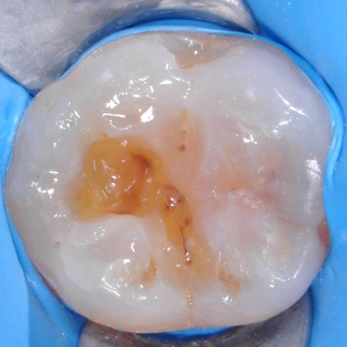 жевательный зуб после удаления кариеса под пломбой