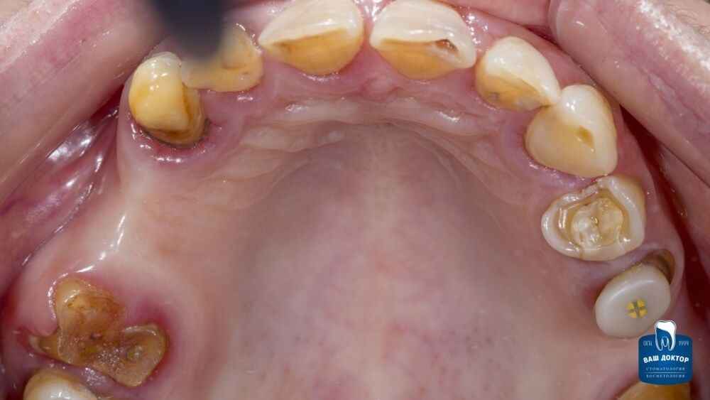 состояние до протезирования зубов циркониевыми коронками