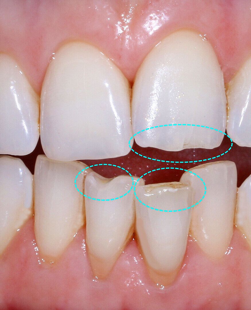 окклюзионная травма зубов