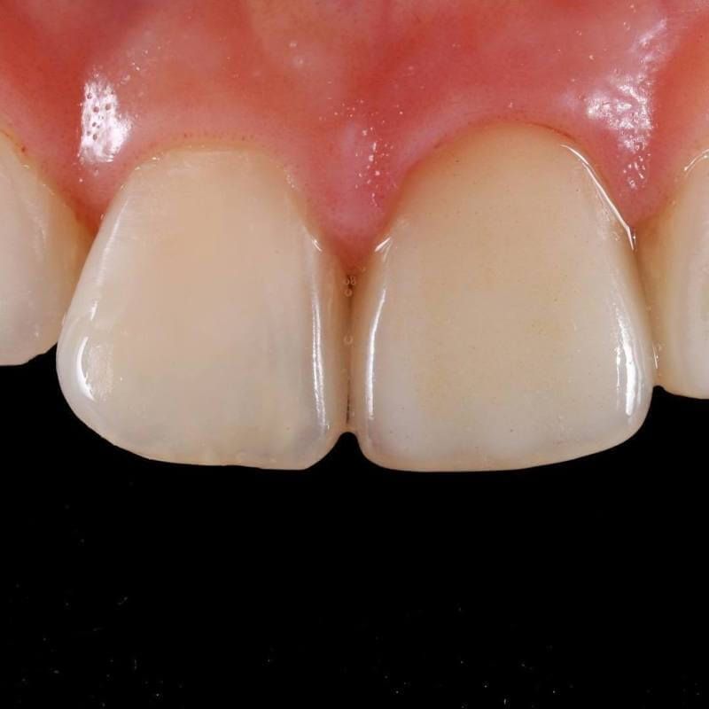 передний зуб после лечения каналов, укрепления штифтом и протезирования