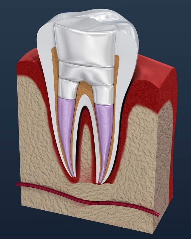Зуб после лечения каналов
