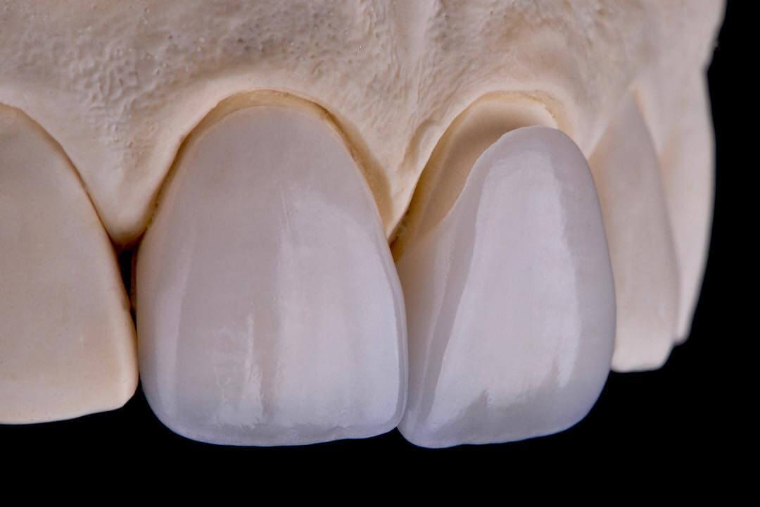 керамические виниры на передние зубы