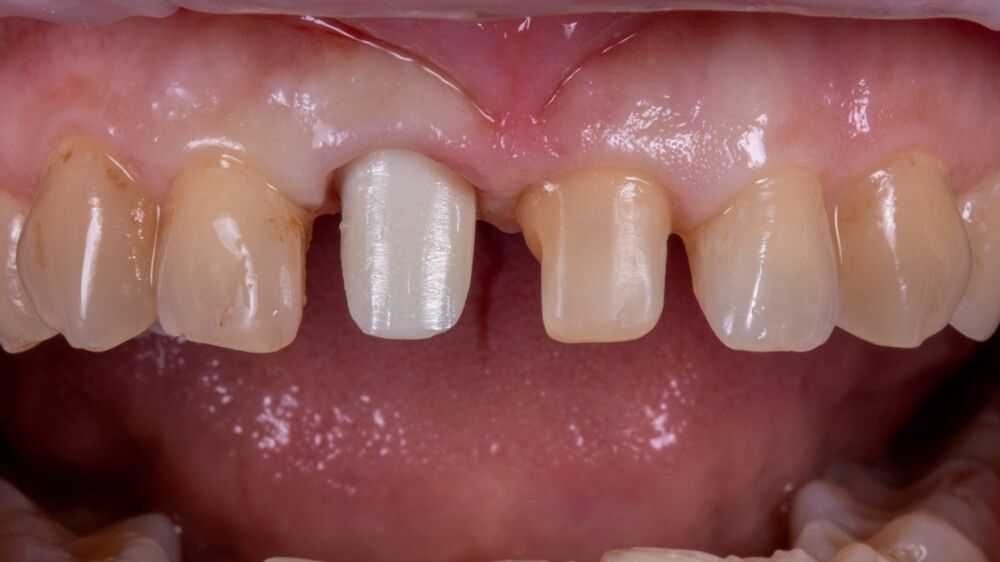 циркониевый абатмент и зуб подготовленные к протезированию