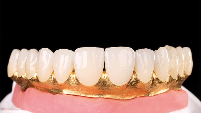 протезирование всех зубов циркониевыми коронками