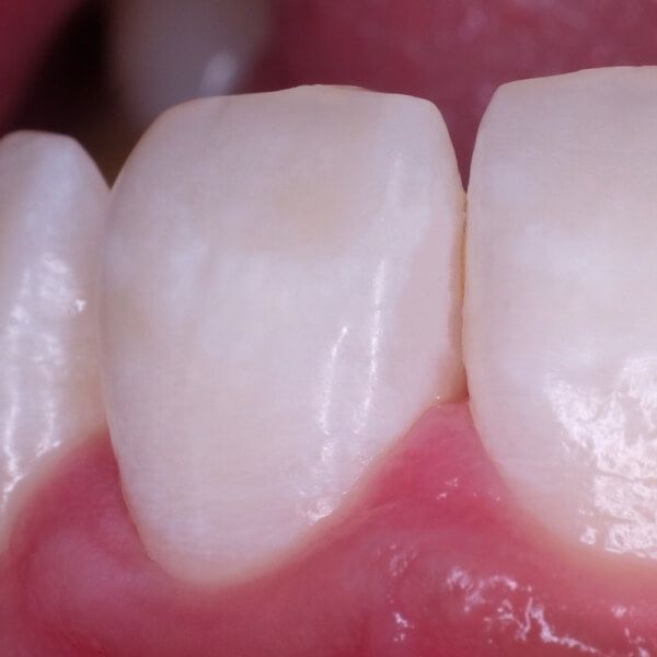 здоровый зуб после лечения кариеса
