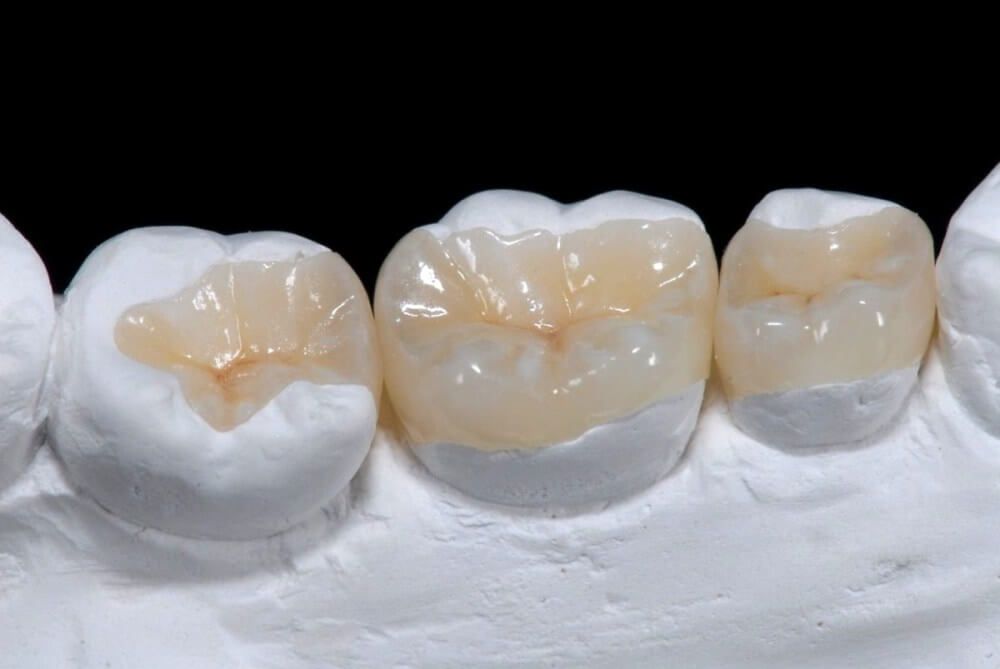 макет трех зубов с керамическими вкладками предназначенными для протезирования после лечения глубокого кариеса