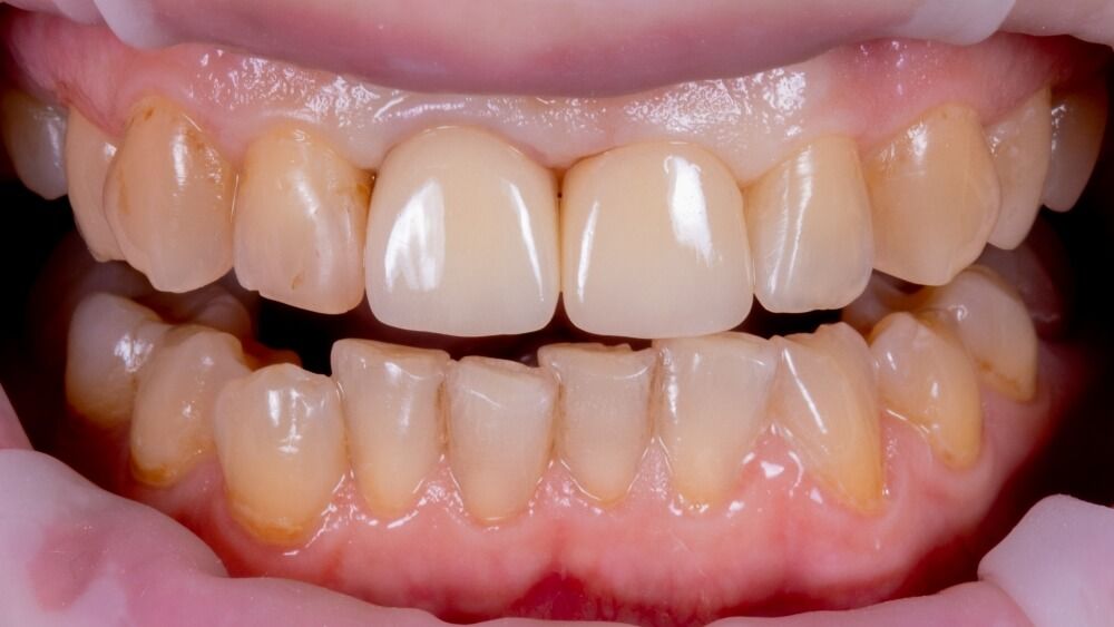 передние зубы после имплантации и протезировани