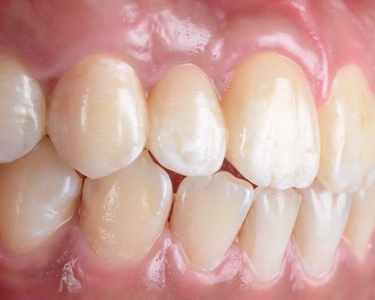 зубы после протезирования мостом из диоксида циркония