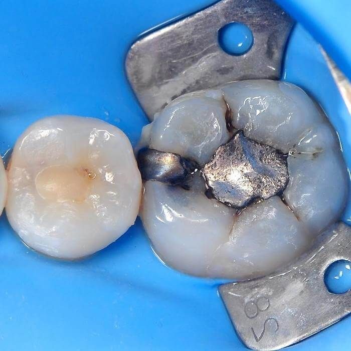 зуб пораженный кариесом под пломбой