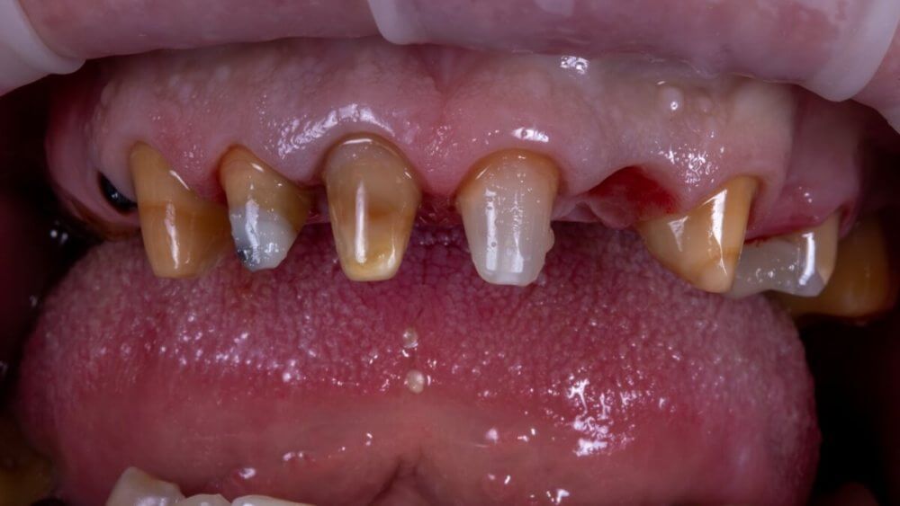 зубы верхней челюсти после препарирования