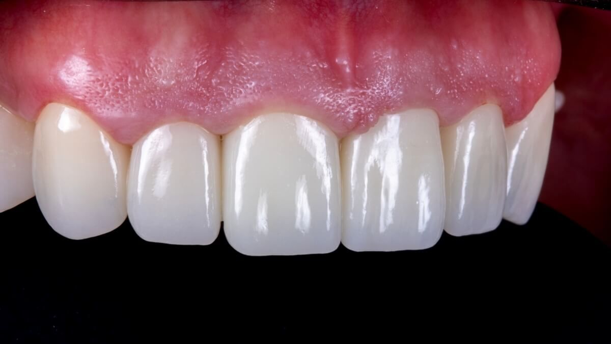 Циркониевые коронки на 6-ти передних зубах