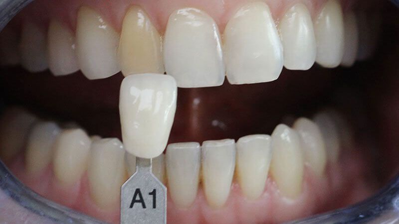 темный оттенок эмали зуба исправляется установкой виниров на зубы